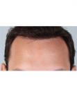After Hair Transplant&nbsp;Hairlines