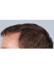 After Hair Transplant&nbsp;Front