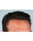 After Hair Transplant&nbsp;Hairlines