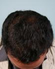 After Hair Transplant&nbsp;Hairlines