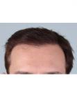 After Hair Transplant &nbsp;Front