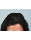 After Hair Transplant&nbsp;Hair Thinning