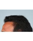 After Hair Transplant&nbsp;Hairlines