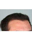 After Hair Transplant&nbsp;Hairlines