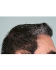 After Hair Transplant&nbsp;Temporal Hairline