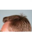 After Hair Transplant&nbsp;Hairlines