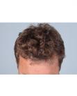 After Hair Transplant&nbsp;Hairlines