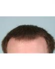 After Hair Transplant &nbsp;Front