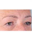 After Hair Transplant &nbsp;Eyebrows