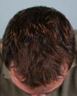 After Hair Transplant&nbsp;Hairlines