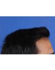 After Hair Transplant&nbsp;Front