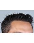 After Hair Transplant&nbsp;Front