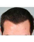 After Hair Transplant&nbsp;Hairlines