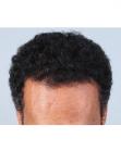 After Hair Transplant&nbsp;Hairlines