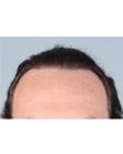 After Hair Transplant &nbsp;Temporal Hairline