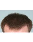 After Hair Transplant&nbsp;Front
