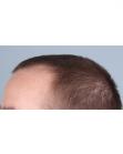 Before Hair Transplant&nbsp;Front