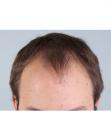 Before Hair Transplant&nbsp;Front