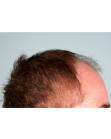 Before Hair Transplant&nbsp;Front