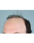 Before Hair Transplant&nbsp;Revision