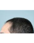 Before Hair Transplant&nbsp;Front