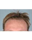 Before Hair Transplant &nbsp;Hairlines