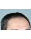 Before Hair Transplant&nbsp;Front