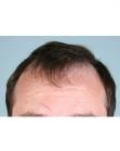Before Hair Transplant &nbsp;Hairlines