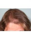 Before Hair Transplant &nbsp;Hair Thinning