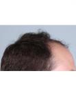 Before Hair Transplant&nbsp;Front