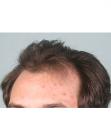 Before Hair Transplant&nbsp;Hairlines