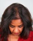 Before Hair Transplant&nbsp;Hair Thinning