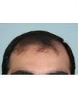 Before Hair Transplant &nbsp;Front