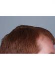 Before Hair Transplant&nbsp;Hairlines