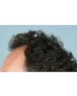 Before Hair Transplant&nbsp;Temporal Hairline