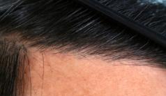 Before Hair Transplant&nbsp;Front
