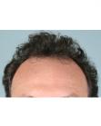 Before Hair Transplant &nbsp;Temporal Hairline