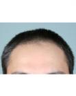 Before Hair Transplant &nbsp;Front