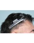 Before Hair Transplant&nbsp;Temporal Hairline