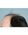 Before Hair Transplant&nbsp;Revision