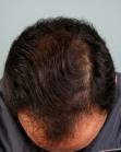Before Hair Transplant&nbsp;Hairlines