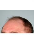 Before Hair Transplant&nbsp;Front