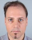 Before Hair Transplant &nbsp;Revision