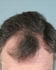 Before Hair Transplant&nbsp;Front