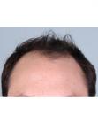 Before Hair Transplant &nbsp;Front
