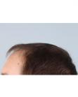 Before Hair Transplant&nbsp;Front