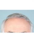Before Hair Transplant &nbsp;Hairlines