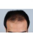 Before Hair Transplant&nbsp;Front