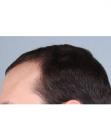 Before Hair Transplant&nbsp;Hairlines