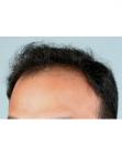 Before Hair Transplant&nbsp;Hairlines